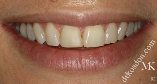 porcelain veneers before