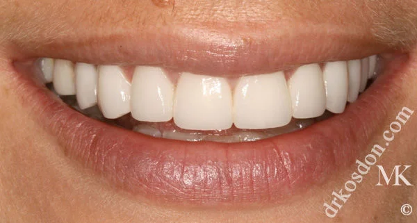 porcelain veneers after