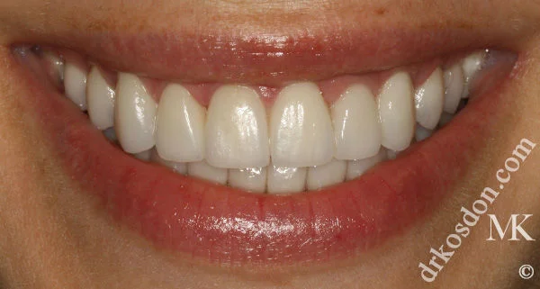 Porcelain Veneers