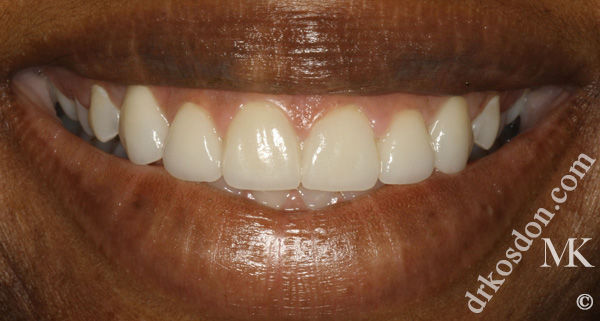 Porcelain Veneers