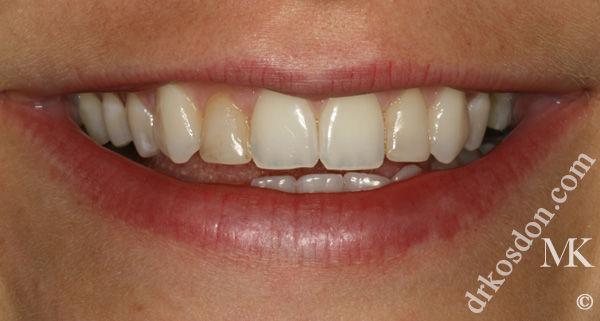 porcelain veneers before