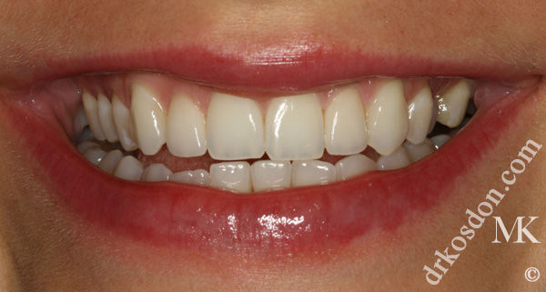 porcelain veneers after