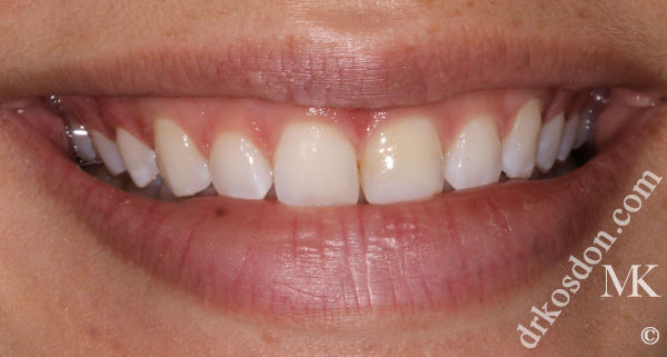 porcelain veneers before