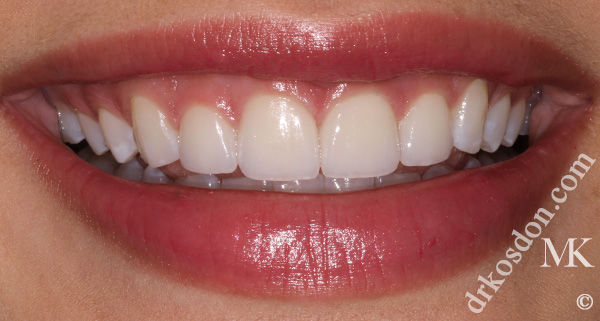 Porcelain Veneers