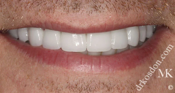 Porcelain Veneers