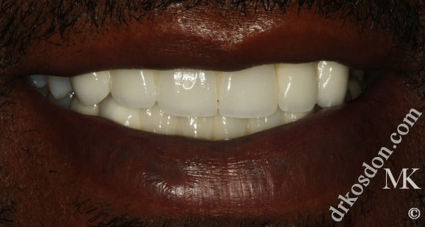 Porcelain Veneers