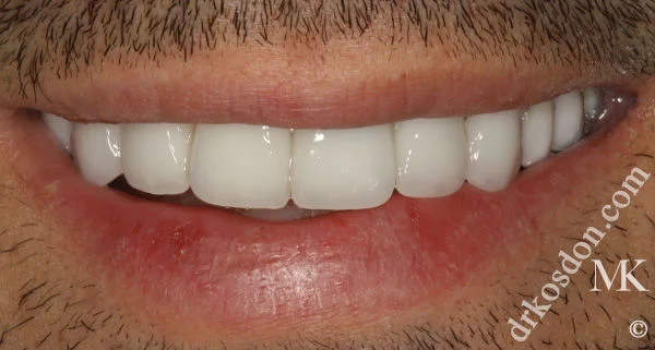 Porcelain Veneers