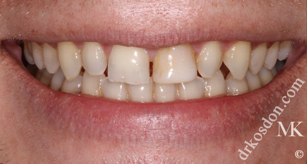 porcelain veneers before