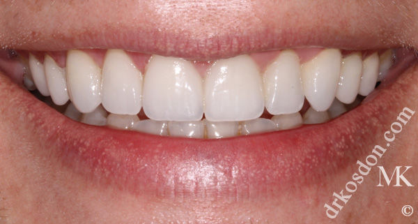 porcelain veneers after