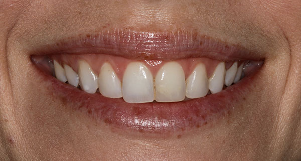 porcelain veneers before