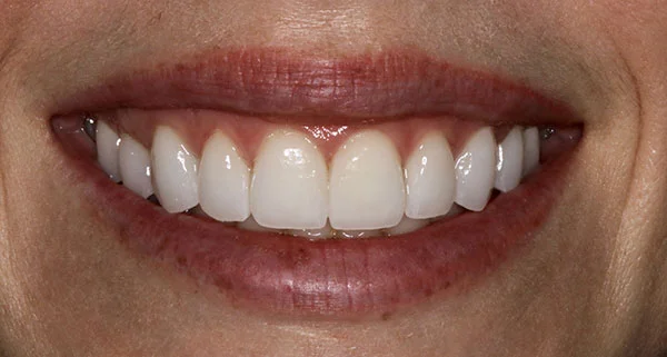 Porcelain Veneers