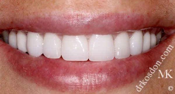 porcelain veneers after