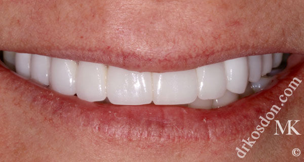 porcelain veneers after