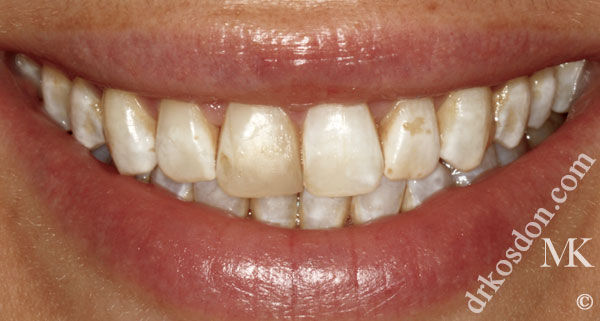 porcelain veneers before