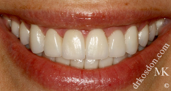 porcelain veneers after