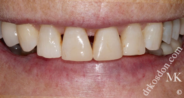 porcelain veneers before