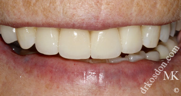 porcelain veneers after