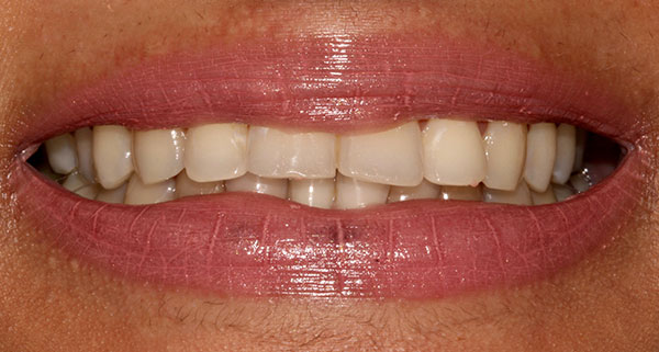 porcelain veneers before