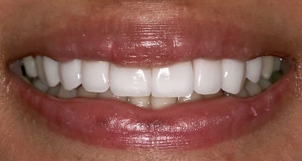 porcelain veneers after