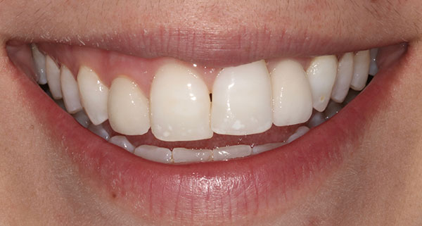 porcelain veneers before