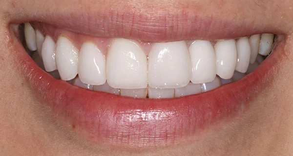 Porcelain Veneers