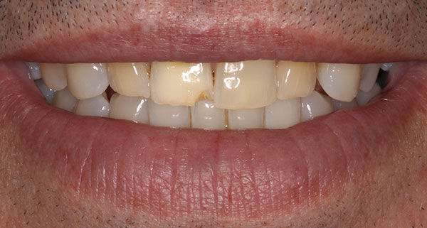 porcelain veneers before