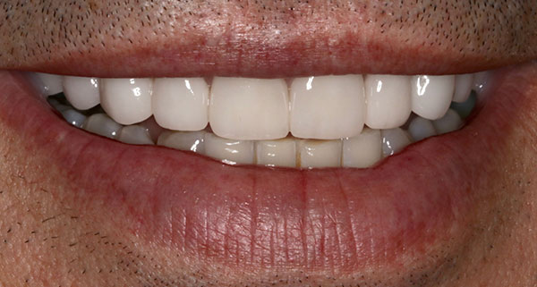 Porcelain Veneers