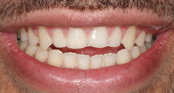 porcelain veneers before