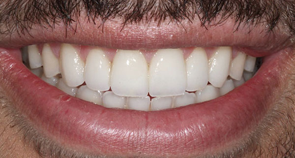 porcelain veneers after