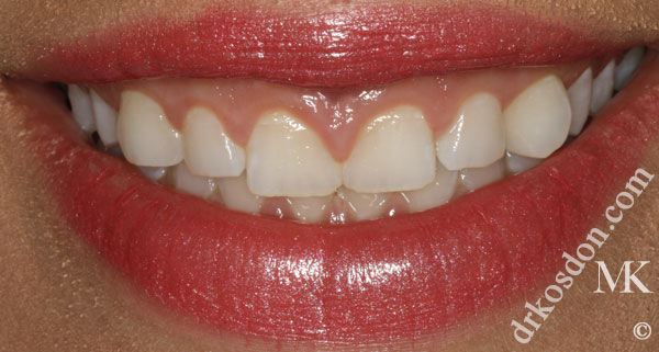 porcelain veneers before