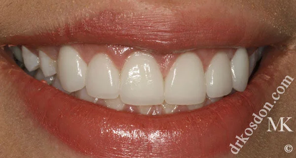 Porcelain Veneers