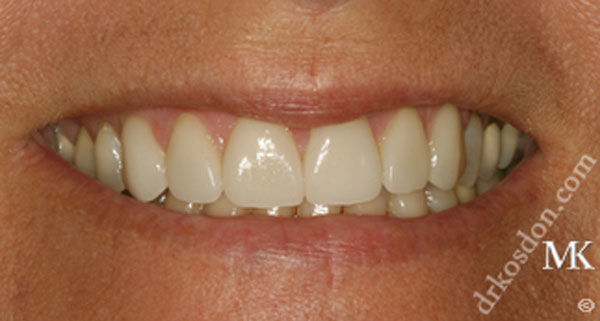 porcelain veneers after