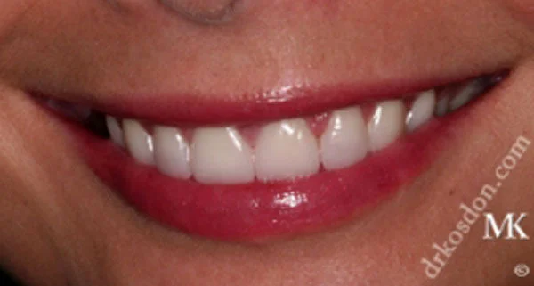 Porcelain Veneers