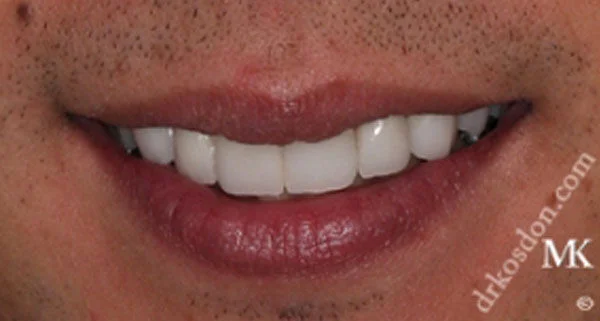 porcelain veneers after