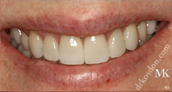 porcelain veneers after