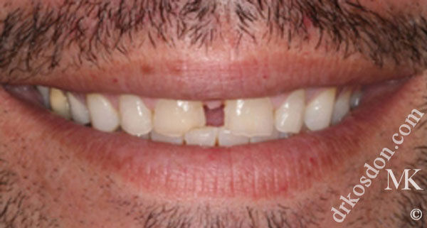 porcelain veneers before