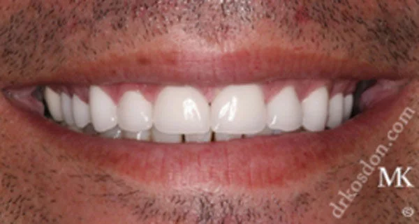 porcelain veneers after