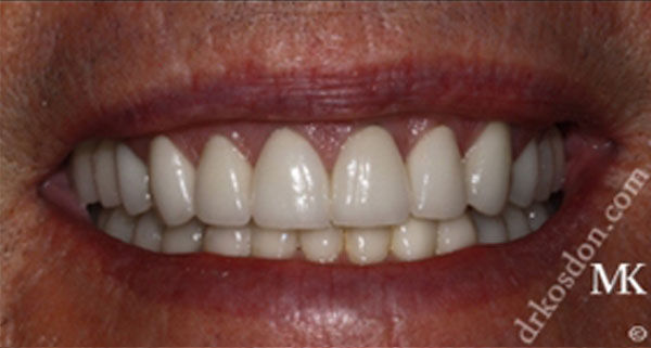 Porcelain Veneers