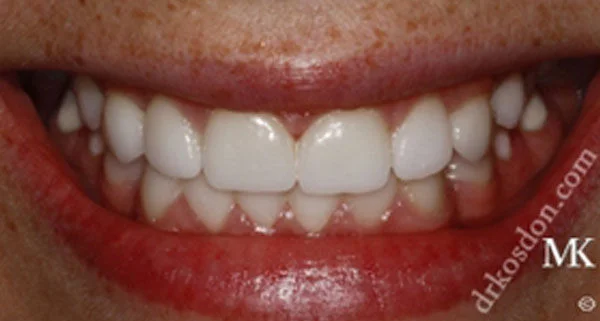 Porcelain Veneers