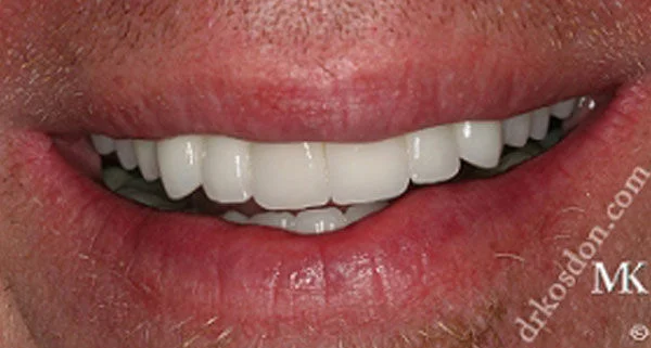 porcelain veneers after