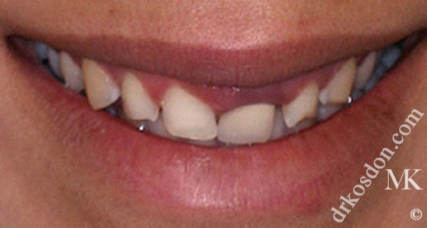 porcelain veneers before