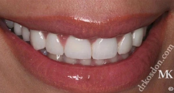 porcelain veneers after