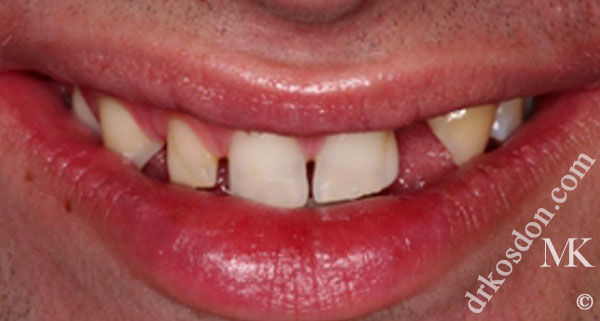 porcelain veneers before