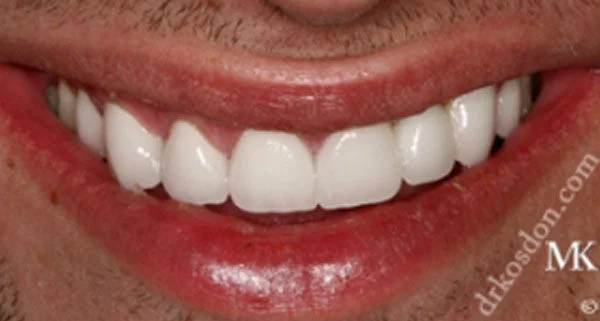 porcelain veneers after