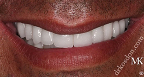 porcelain veneers after