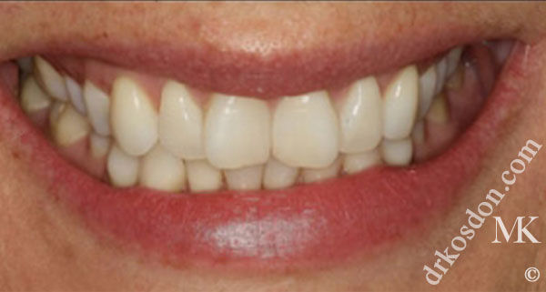 porcelain veneers before