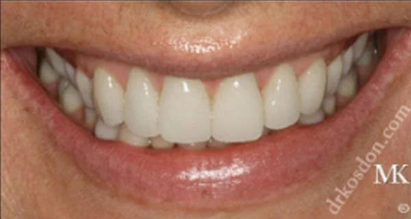 Porcelain Veneers