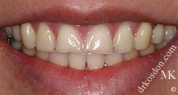 porcelain veneers before