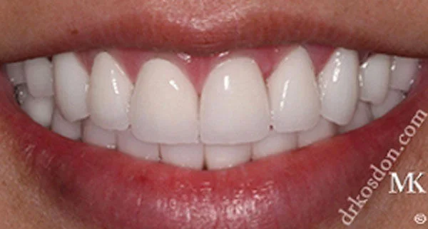 porcelain veneers after