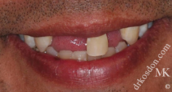 porcelain veneers before
